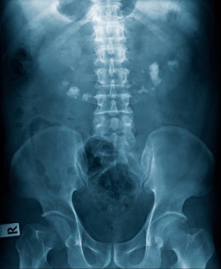 x-ray görüntü spondiloz insan omurga ve leğen kemiği mavi ses tonuyla  