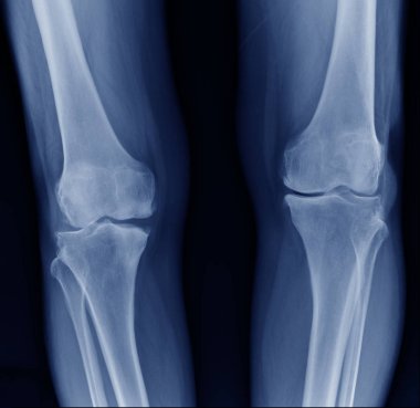 x-ışını Oa diz her iki diz mavi tonda, diz eklemi x-ray görüntü göstermek hafif dejeneratif değişiklik 