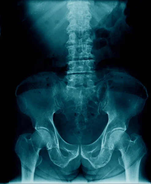 Radiografía Columna Torácica Lumbar Hueso Pélvico Hipoarticular Espondilosis Columna Corporal — Foto de Stock