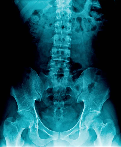 Columna Lumbar Rayos Alta Calidad Tono Azul Imagen Xrau Del — Foto de Stock