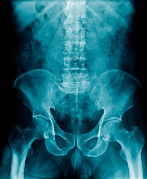 hight quality x-ray lumbar spine in blue tone, xrau image of old man show spondylosis or degeneration of spine and part og hip and pelvic bone