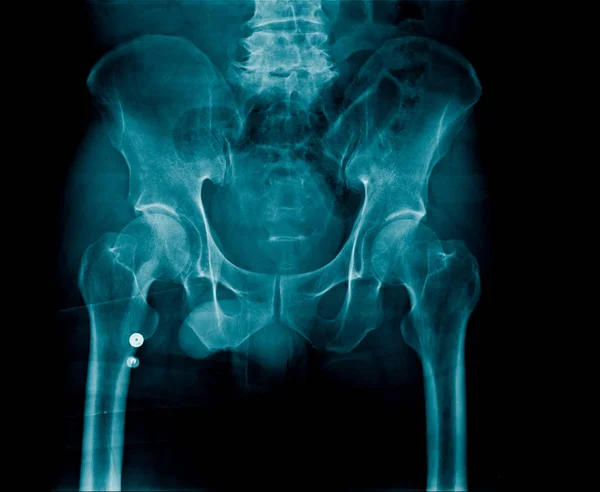 Radiografía Hueso Pélvico Fémur Articulación Cadera Parte Espondilosis Deforme Lumbar — Foto de Stock