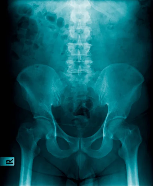 hight quality x-ray lumbar spine in blue tone, xrau image of old man show spondylosis or degeneration of spine and part og hip and pelvic bone