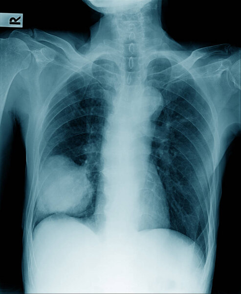 chest x-ray with rigth lower segment lobectomy and secretion infiltration 