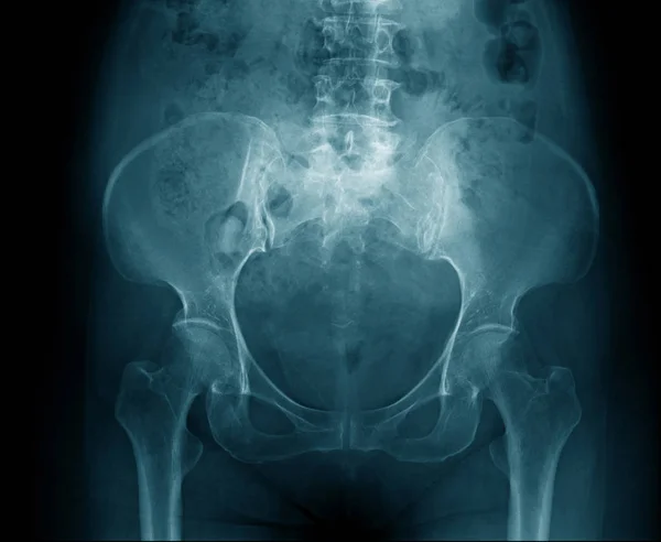 Hueso Pélvico Rayos Pelvis Rayos Alta Calidad Tono Azul — Foto de Stock