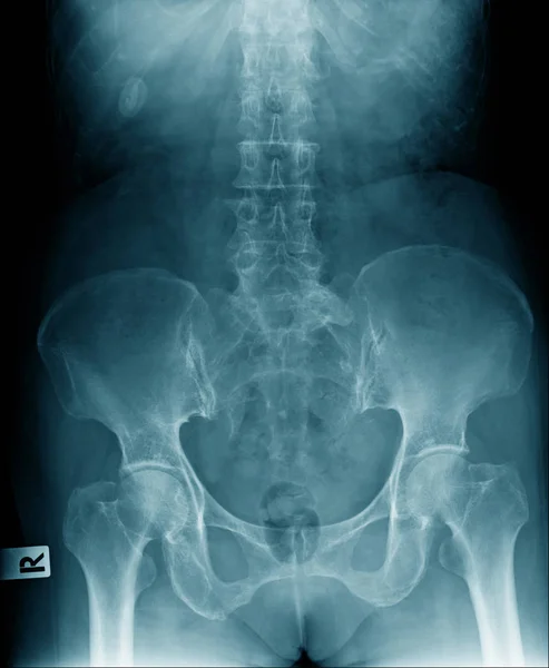 腰椎和胸骨部分骨盆和部分 高质量骨盆和髋关节的 线图像 — 图库照片