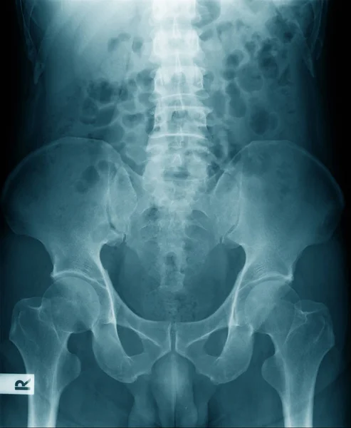 Ray Image Pelvic Part Femur Bone High Quality Pelvis Hip — Stock Photo, Image