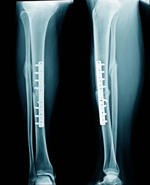 Fratura Perna Ambos Ossos Radiografia Mostram Fixação Tíbia Osso Fratura — Fotografia de Stock