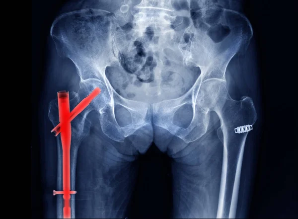 high quality x-ray hip replacement in old man, degenerative change of hip and post operation femur head fixation