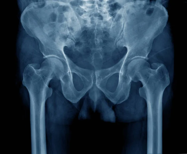 high quality hip x-ray and pelvic bone and part of lumbar spine and femur bone in blue tone