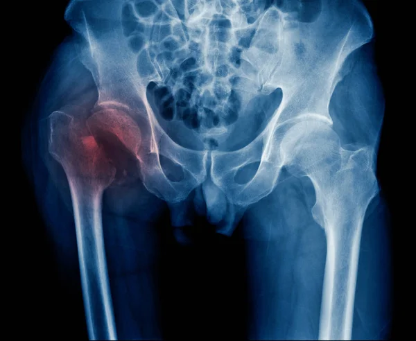 Ray Hip Fracture Old Man Ray Image Intertrochanteric Fracture — Stock Photo, Image