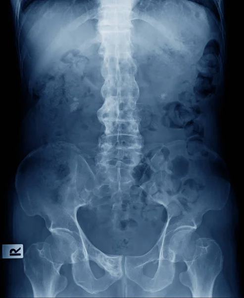 Ray Image Old Man Show Ankylosing Spondylitis Bamboo Spine Degenerative — Stock Photo, Image