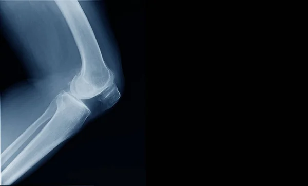 射线膝盖横幅为网站 膝盖的高质量在屈曲位置 — 图库照片