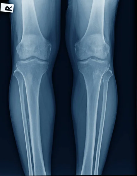 膝青色のトーン 膝関節の 線像で両方の膝を示す軽度の変性変化 — ストック写真