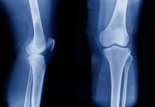 Rayos Rodilla Ambas Rodillas Tono Azul Imagen Rayos Articulación Rodilla — Foto de Stock