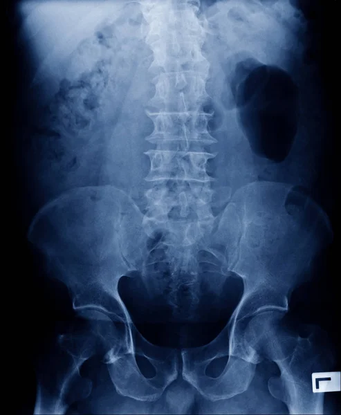 Espondilosis Imagen Rayos Columna Vertebral Humana Hueso Pélvico Tono Azul —  Fotos de Stock