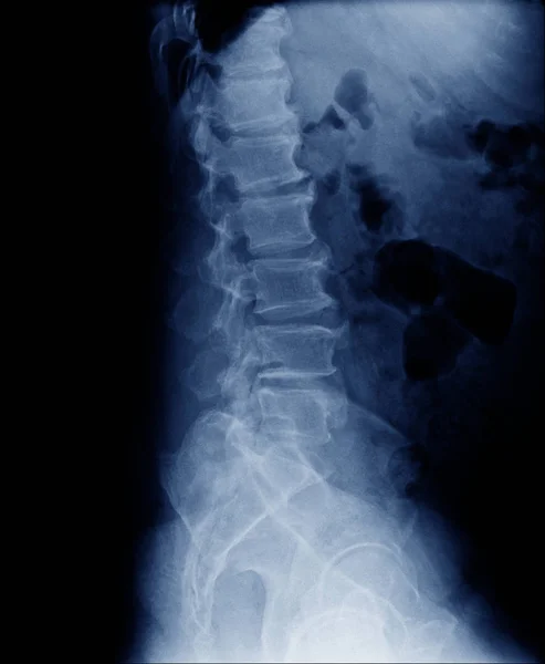 lateral view of human spine, degenerative change of spine show spinal stenosis in blue tone