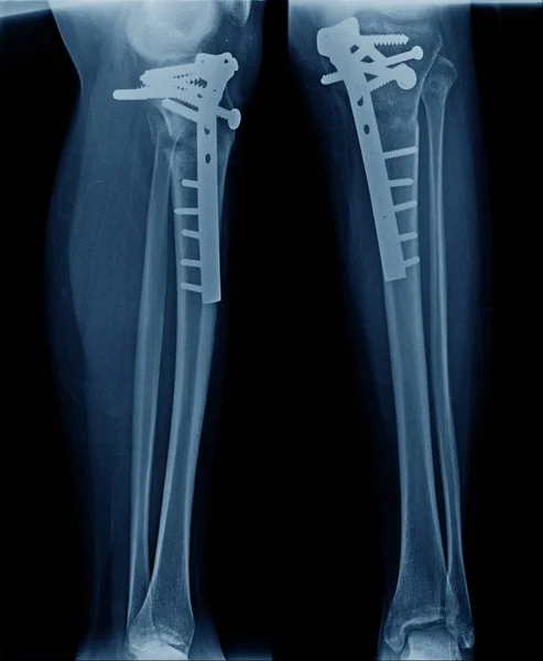 Ray Image Leg Show Tibia Bone Fixation Hight Quality Fixation — Stock Photo, Image