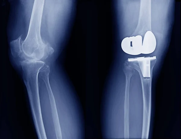 Зображення Рентгенівського Зображення Tka Високоякісне Рентгенівське Заміною Колінного Суглоба — стокове фото