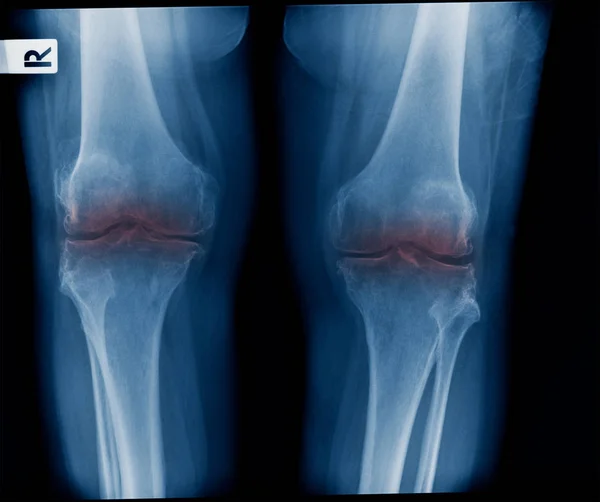 膝青色のトーン 膝関節の 線像で両方の膝を示す軽度の変性変化 — ストック写真