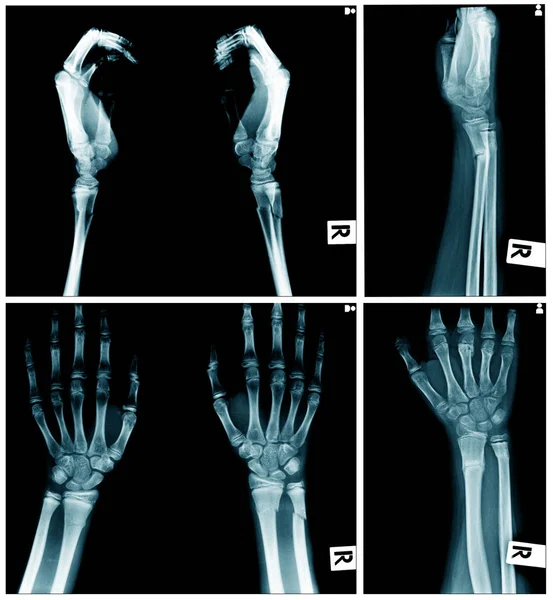 Collectie Van Ray Beeld Met Hand Ray Laterl Uitzicht Stockafbeelding