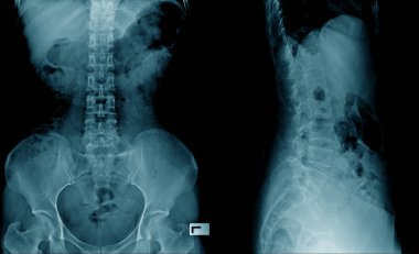 x-ray görüntü omurga ve Kalça eklemi Ap/Lateral görünüm 