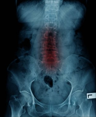 Kırmızı yüksek ışık, teşvik veya kalsifikasyon, lomber gövdesi ile lomber omurga Haritayı dejenerasyonu x-ray görüntüsü 