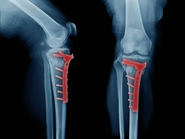 Ray Image Leg Bone Fracture Proximal Tibia Internal Fixation Lateral — Stock Photo, Image