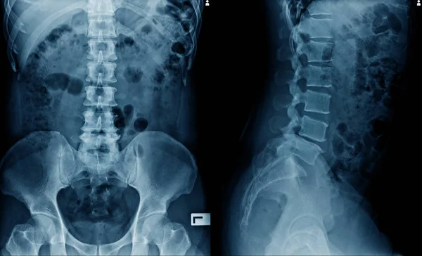 Röntgenbild Der Wirbelsäule Und Des Hüftgelenks Lateral Gesehen — Stockfoto