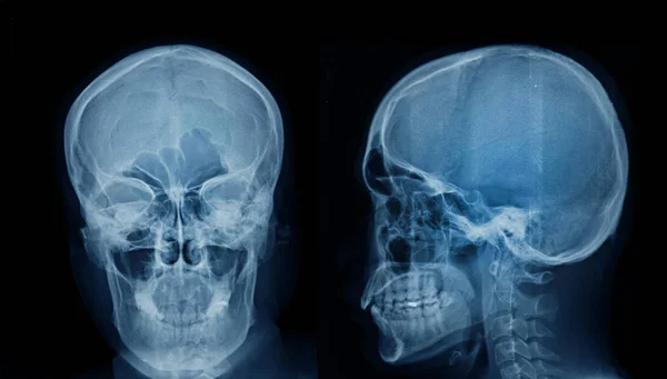 head x-ray AP and lateral view, x-ray image of skull frontal and side view on dark background