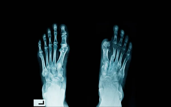 Рентген Стопи Рентгенівське Зображення Пацієнта Діабету Нарізаним Великим Пальцем Інфікована — стокове фото