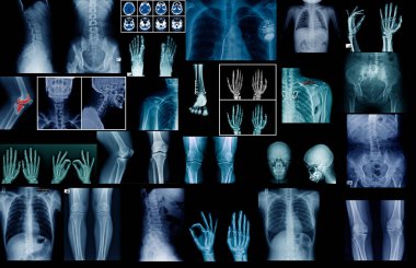 büyük koleksiyon x-ray görüntü üzerinde siyah veya koyu arka plan