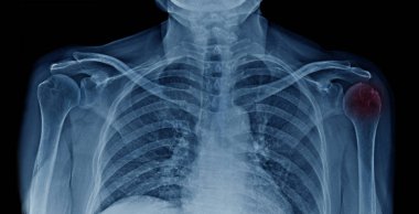 pazı kemiği başkanı osteoartrit 