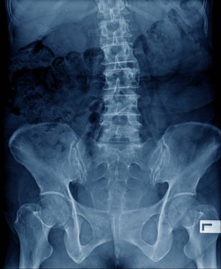 yaşlı adam röntgen, leğen kemiği ile lomber x-ray görüntü