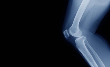 x-ray görüntü Oa diz 