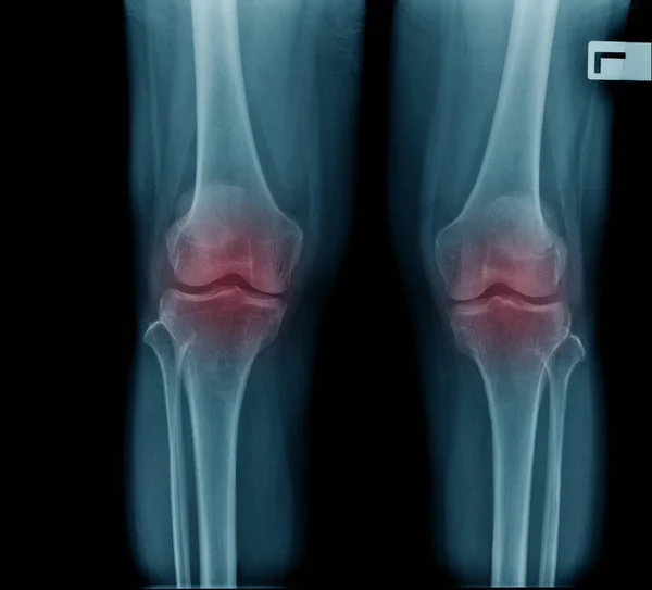 Osteoarthritis Knee ( OA Knee ) ( Film x-ray both knee with arthritis