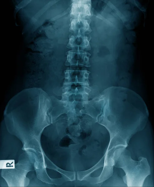 Old man x-ray, lumbar x-ray image with pelvic bone — Stock Photo, Image