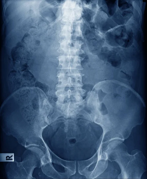 Рентген старика, поясничное рентгеновское изображение с тазовой костью — стоковое фото