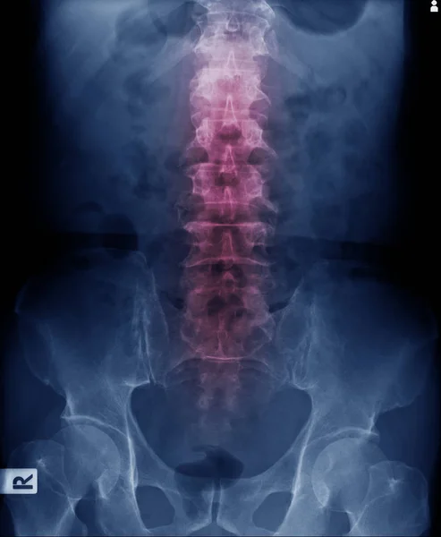 Rayos X de hombre viejo, imagen de rayos X lumbares con hueso pélvico — Foto de Stock