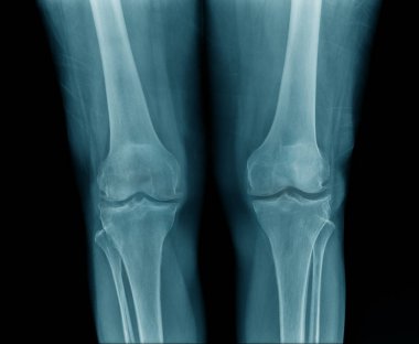 yaşlı adamın yüksek kaliteli x-ray diz eklemi, mavi tonda siyah arka plan yaşlı adamın Oa diz