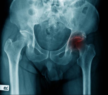 Yaşlı kadının x-ray görüntüsü kalça ekleminde dejeneratif değişim gösteriyor, kalça avasküler nekroz.
