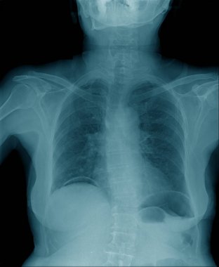 göğüs röntgeni , mavi tonda yüksek kaliteli göğüs x-ray görüntü