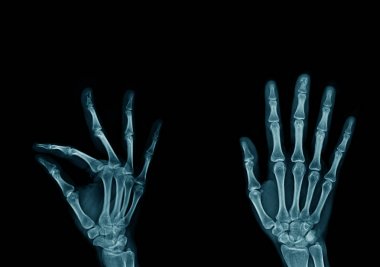 x-ray görüntü el ve parmak, el ve parmak eylem görüntü koyu zemin üzerine mavi ses tonuyla x-ışını