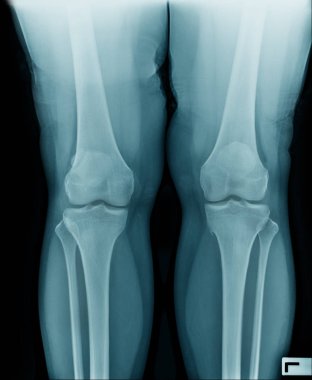 yaşlı adamın yüksek kaliteli x-ray diz eklemi, mavi tonda siyah arka plan yaşlı adamın Oa diz