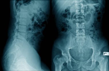 lomber spondiloz isi x-Ray görüntü Ap ve lateral görünüm