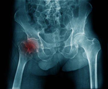 Yaşlı kadının x-ray görüntüsü kalça ekleminde dejeneratif değişim gösteriyor, kalça avasküler nekroz.