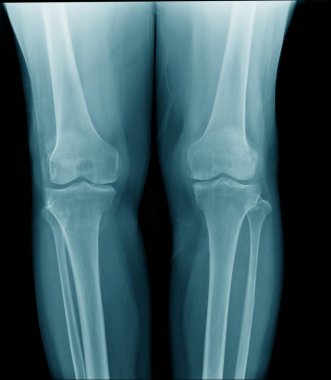 yaşlı adamın yüksek kaliteli x-ray diz eklemi, mavi tonda siyah arka plan yaşlı adamın Oa diz