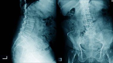 lomber spondiloz isi x-Ray görüntü Ap ve lateral görünüm
