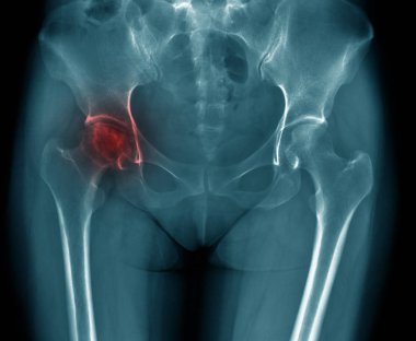 Yaşlı kadının x-ray görüntüsü kalça ekleminde dejeneratif değişim gösteriyor, kalça avasküler nekroz.