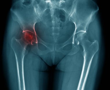x-ray image of old woman show degenerative change of hip joint, hip avascular necrosis right side of alderly clipart